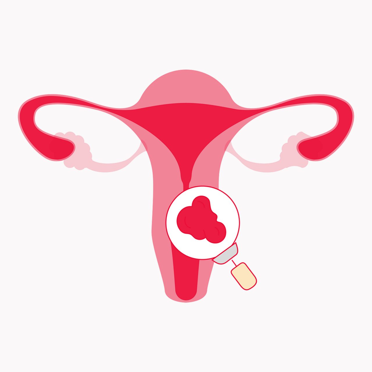 Endometrial Cancer mob