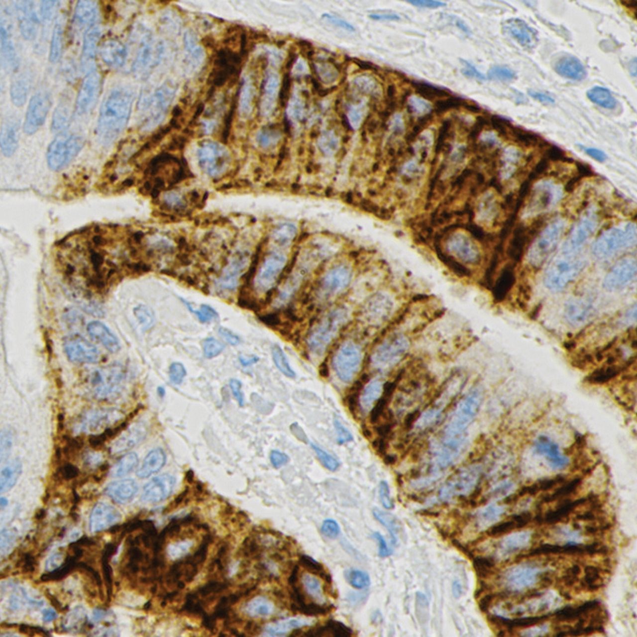 Photo showing an example of moderate CLDN18 staining