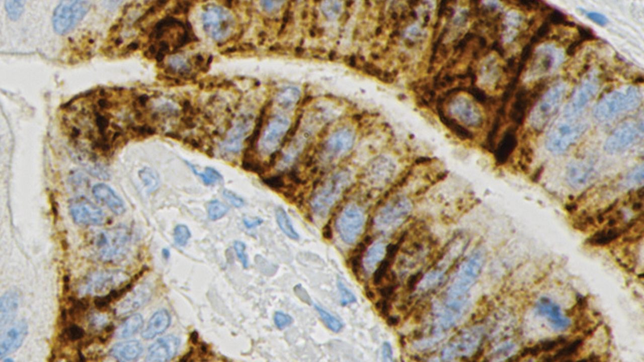 Photo showing an example of moderate CLDN18 staining