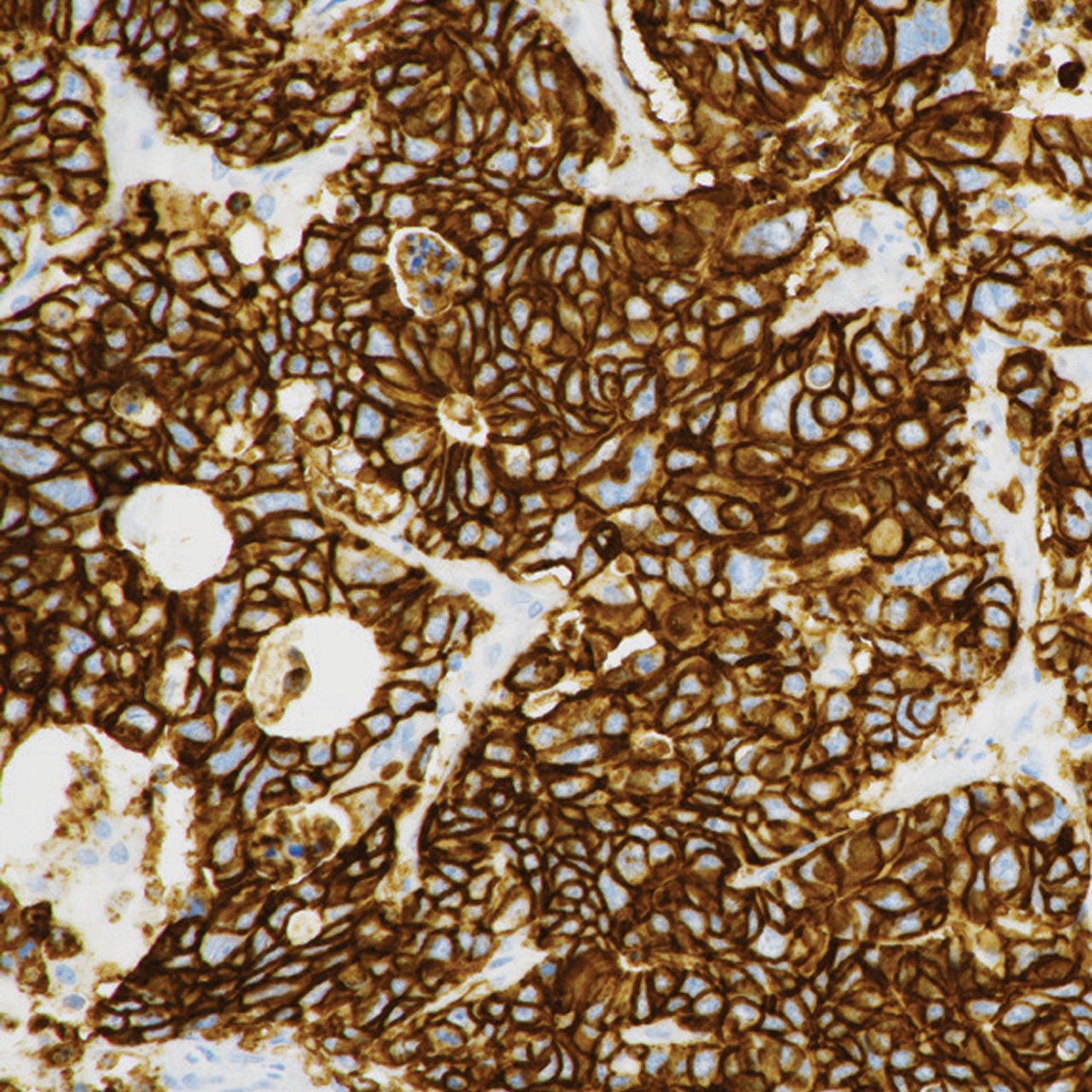 Photo showing an example of strong CLDN18 staining