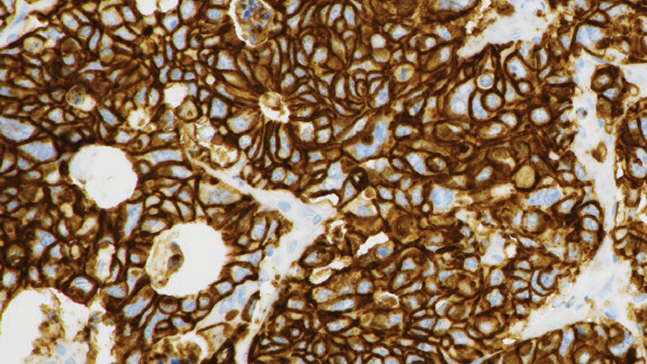 Photo showing an example of strong CLDN18 staining