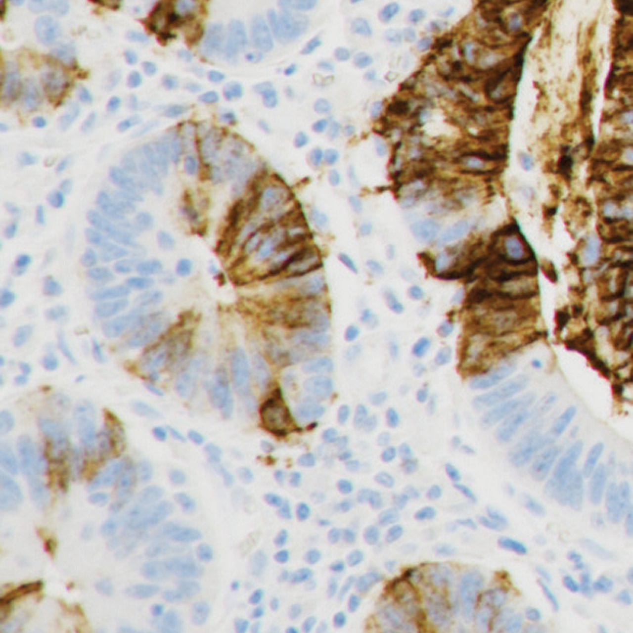 Photo showing an example of weak CLDN18 staining