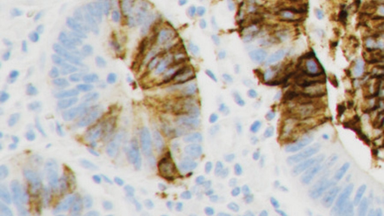 Photo showing an example of weak CLDN18 staining