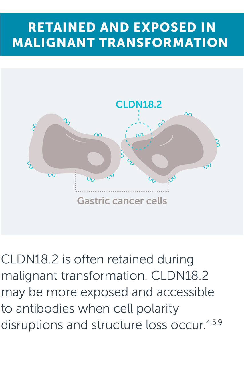CLDN18.2 is often retained during malignant transformation. CLDN18.2 may be more exposed and accessible to antibodies when cell polarity disruptions and structure loss occur.