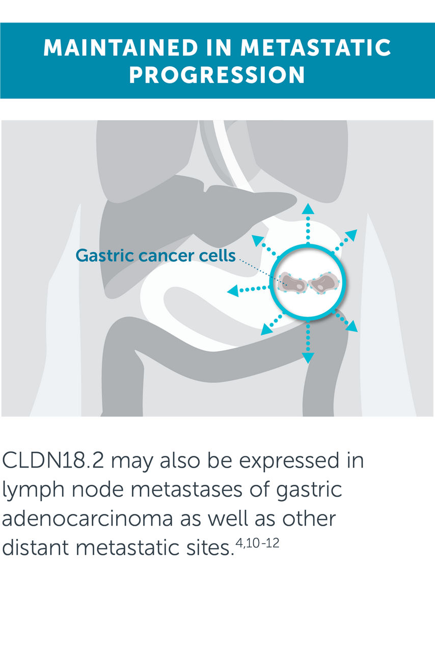 CLDN18.2 may also be expressed in lymph node metastases of gastric adenocarcinoma as well as other distant metastatic sites