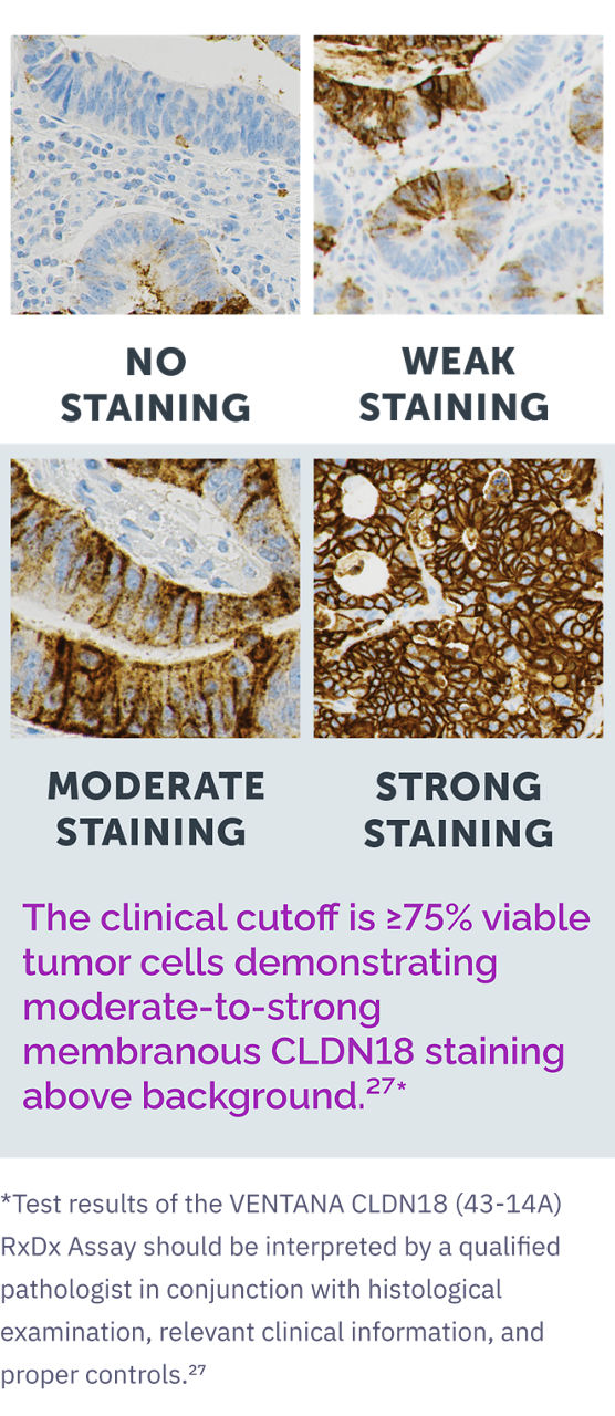 No membranous staining on tumor cells, Weak membranous staining on tumor cells, Moderate membranous staining on tumor cells, Strong membranous staining on tumor cells