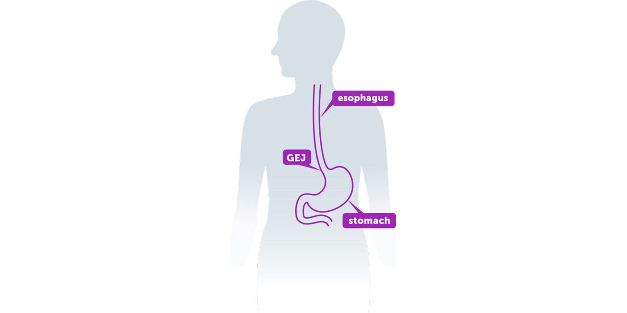 Esophagus, GEJ, and stomach within the human body