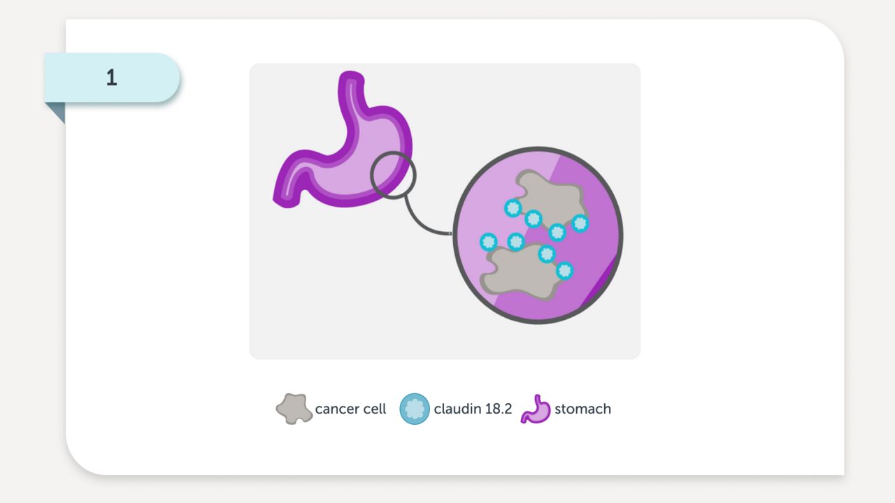 The claudin 18.2 biomarker may become exposed on the surface of stomach cancer cells as the cancer progresses
