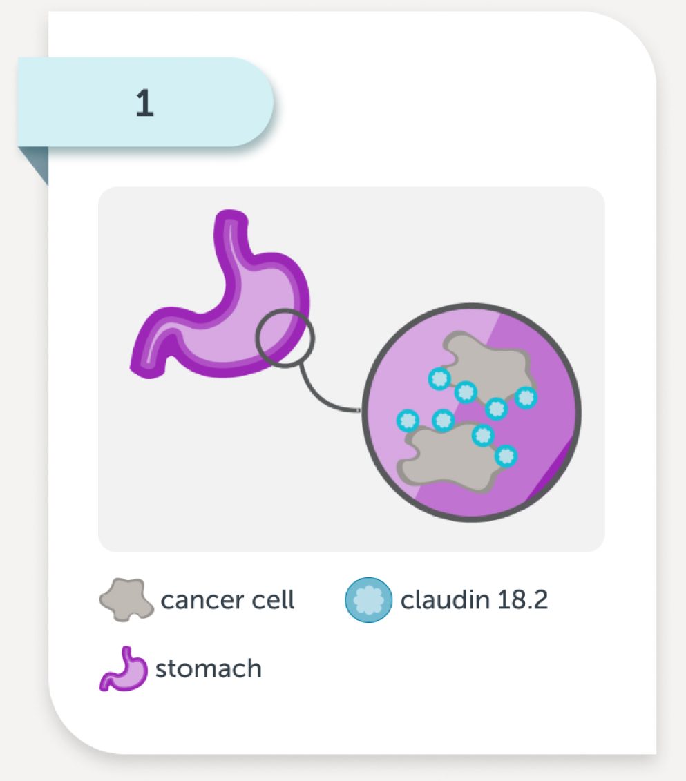 The claudin 18.2 biomarker may become exposed on the surface of stomach cancer cells as the cancer progresses