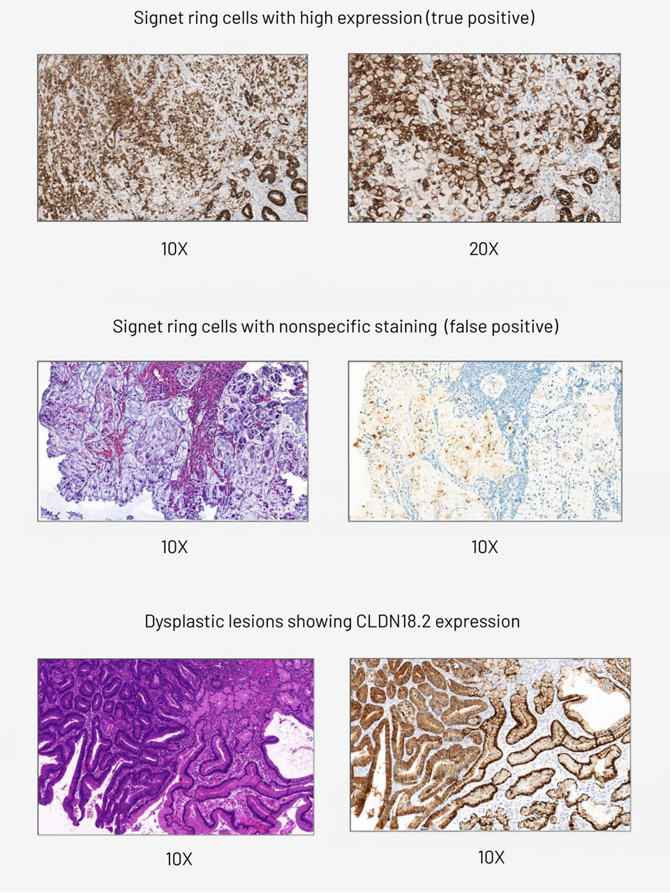 signet-ring-cell-and-dysplastic-lesions