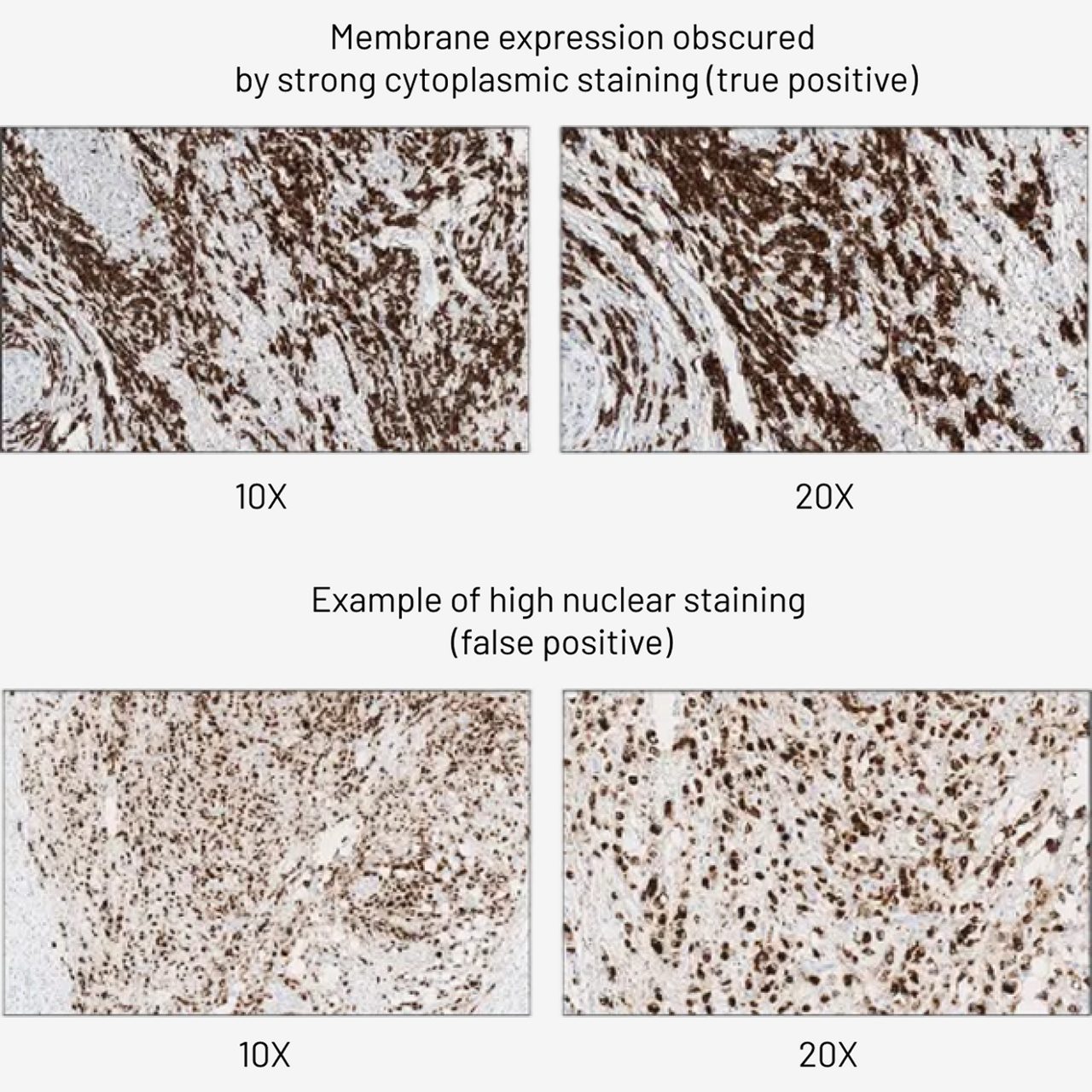 cytoplasmic-vs-nuclear-staining