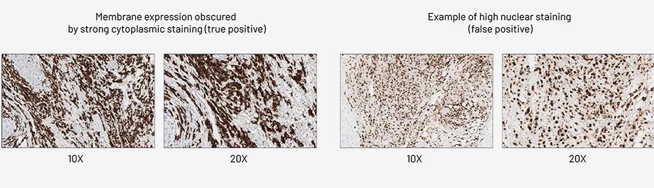cytoplasmic-vs-nuclear-staining