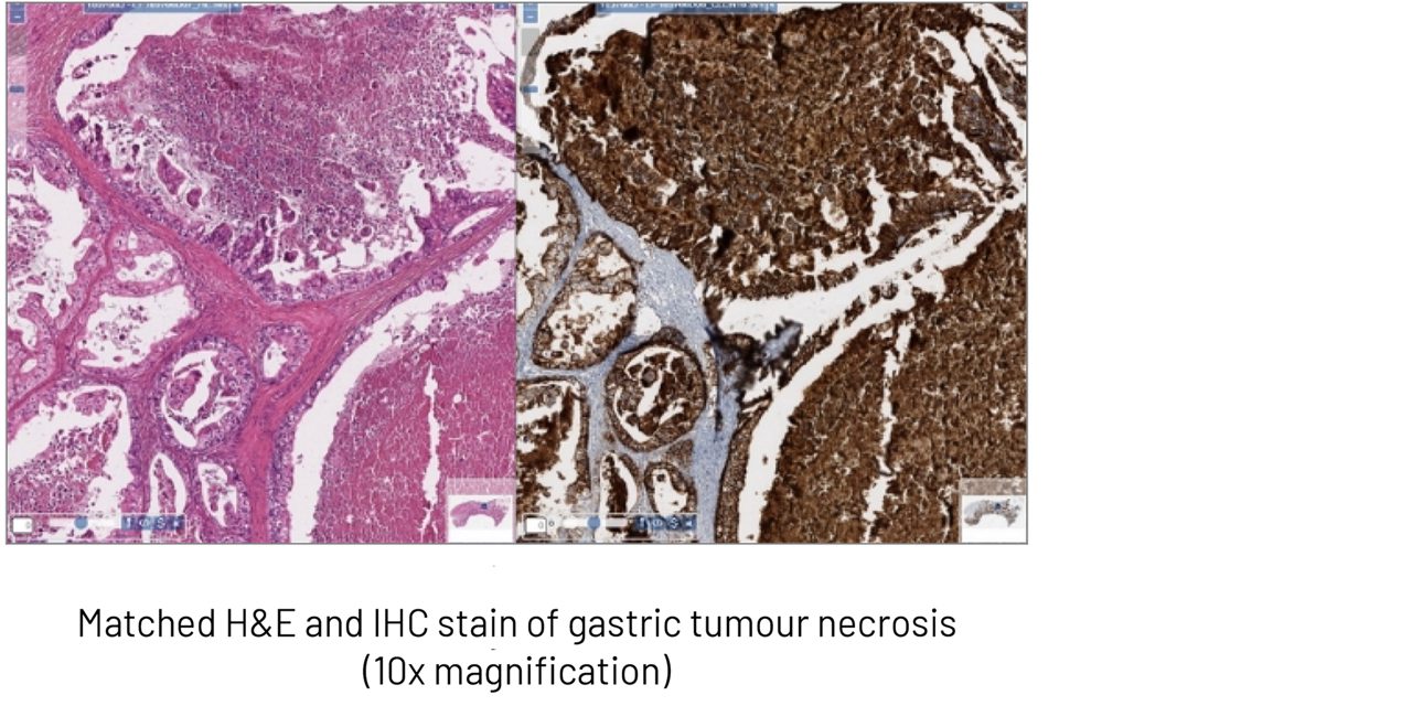 impact-of-necrosis-on-cldn18.2-interpretation