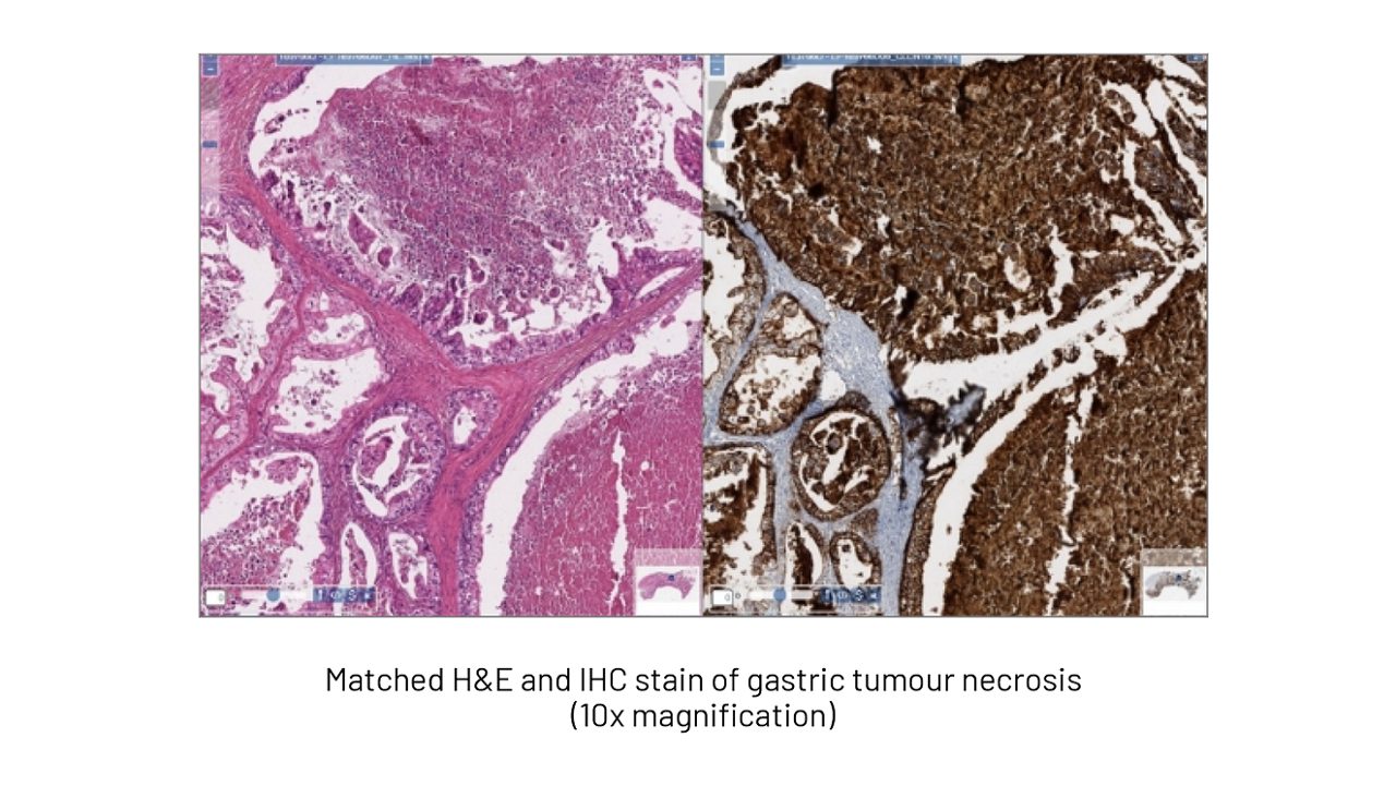 impact-of-necrosis-on-cldn18.2-interpretation