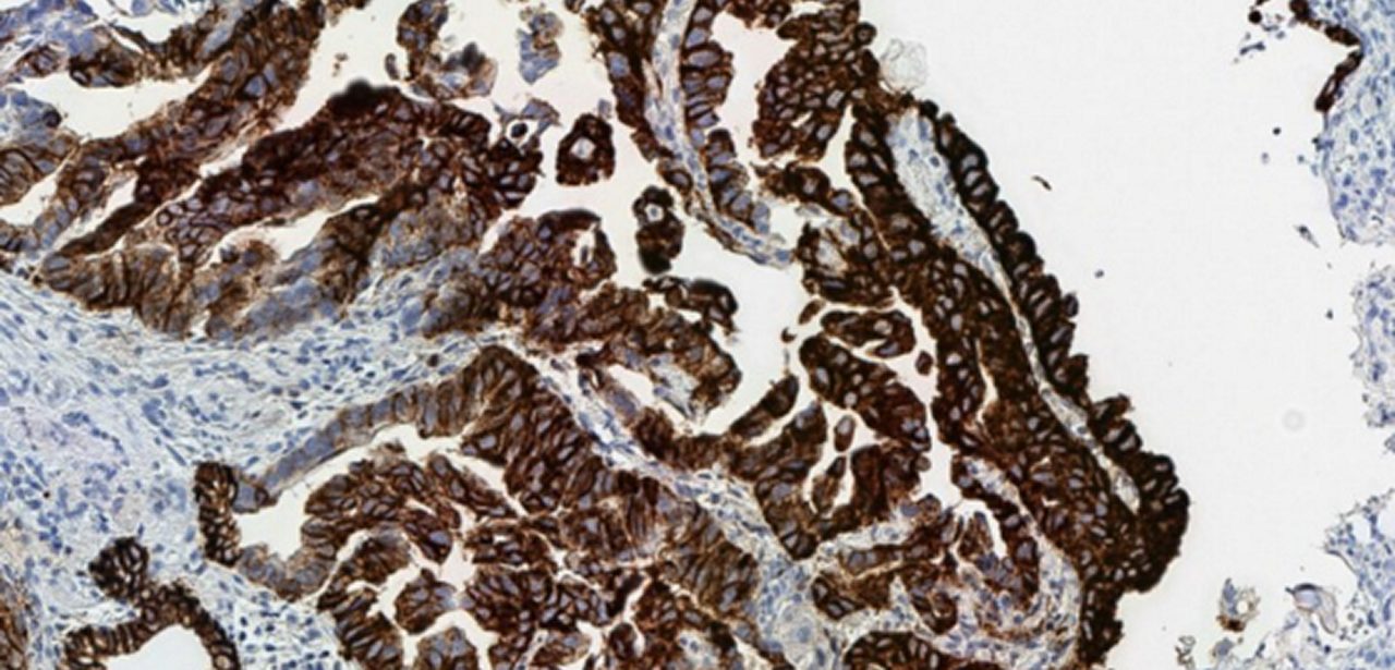 Suboptimal tissue fixation1