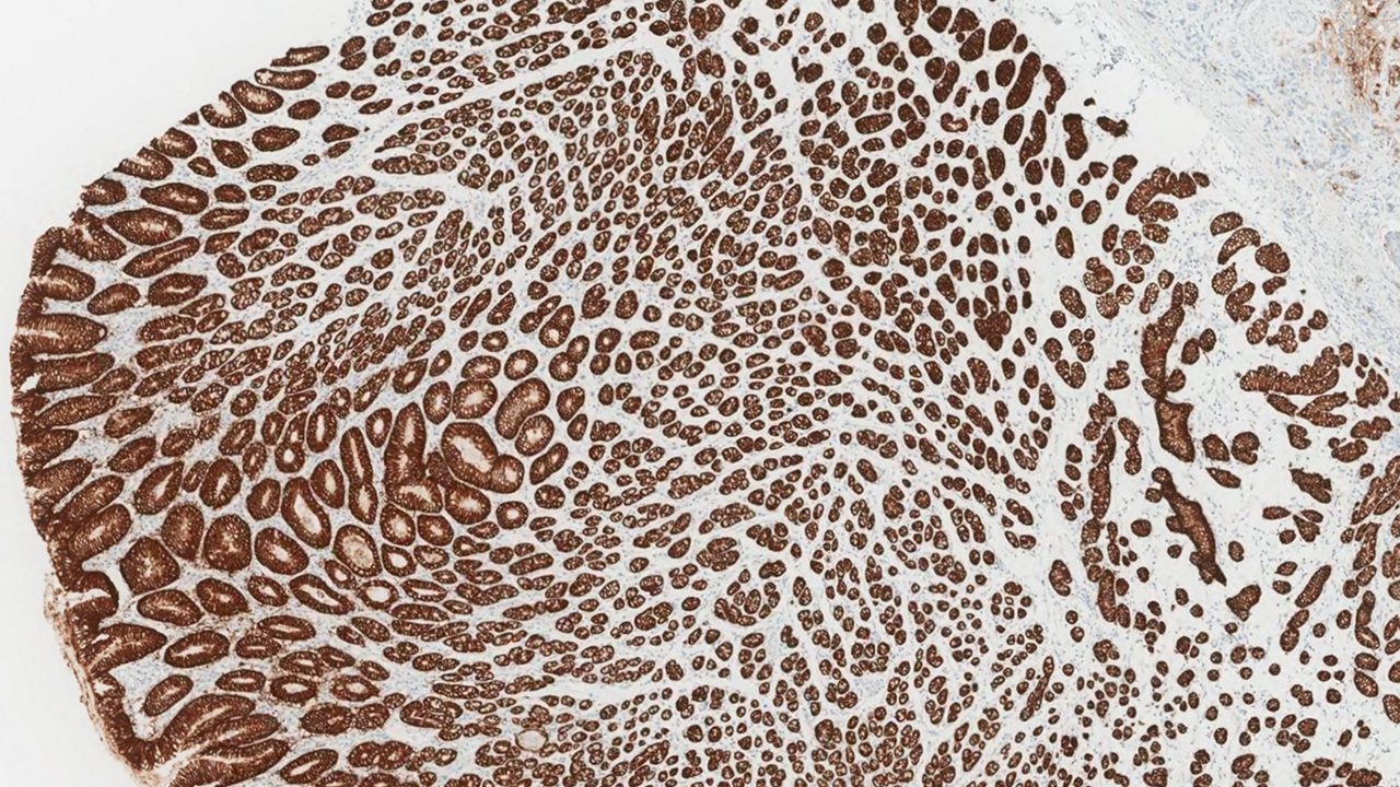 RESECTION OF GC