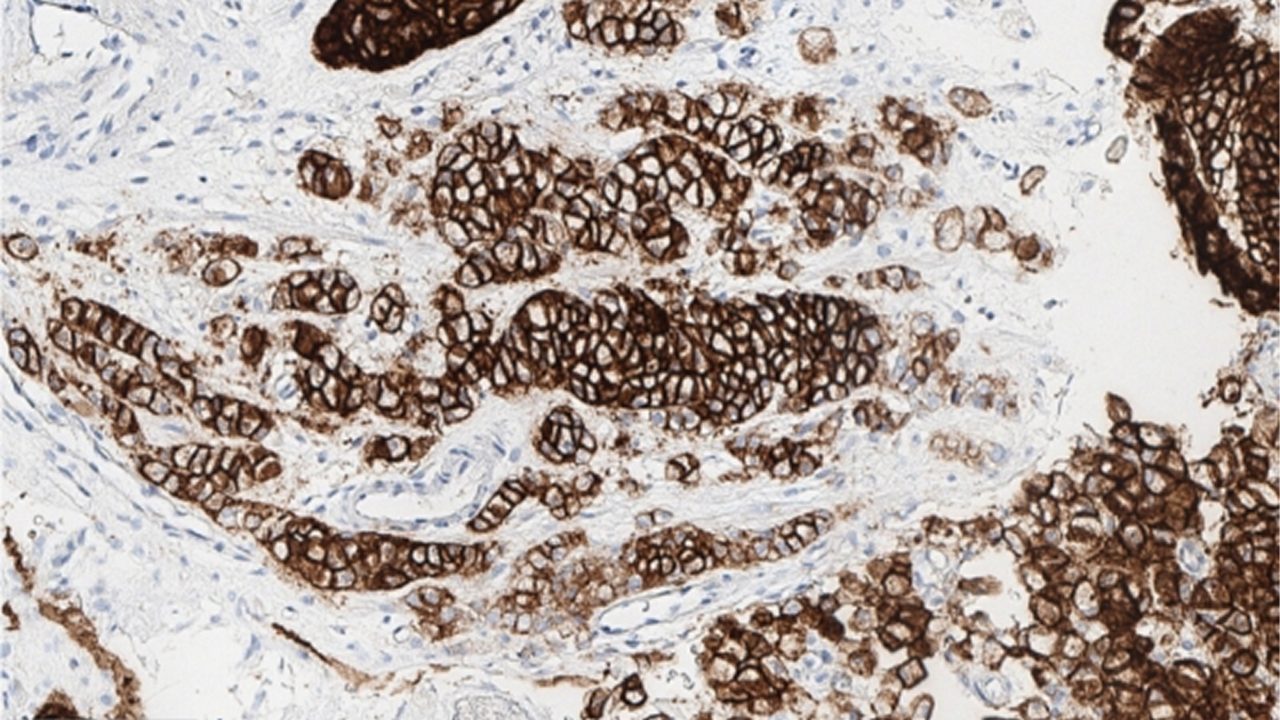 BIOPSY OF GC
