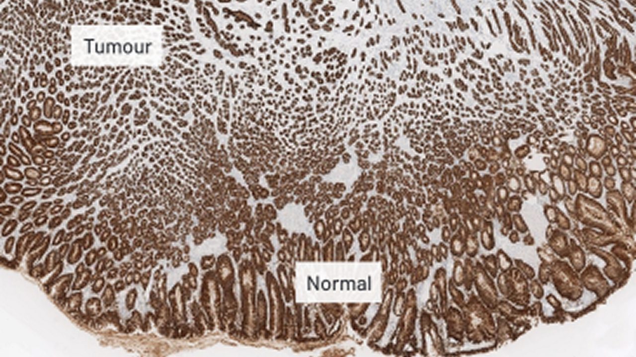 Normal and tumour cell CLDN18 staining at 5x magnification.